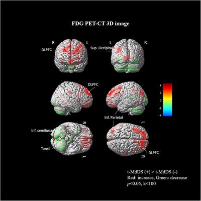 Neural Correlates of Transient Mal de Debarquement Syndrome: Activation of Prefrontal and Deactivation of Cerebellar Networks Correlate With Neuropsychological Assessment